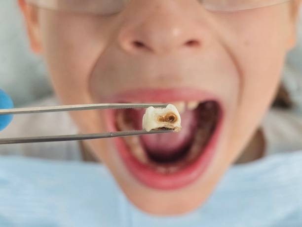 Best Broken or Chipped Tooth Repair in Tracy City, TN